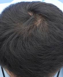 Dクリニック新宿で治療を受けた30代 O型の男性の頭部アフターイメージ
