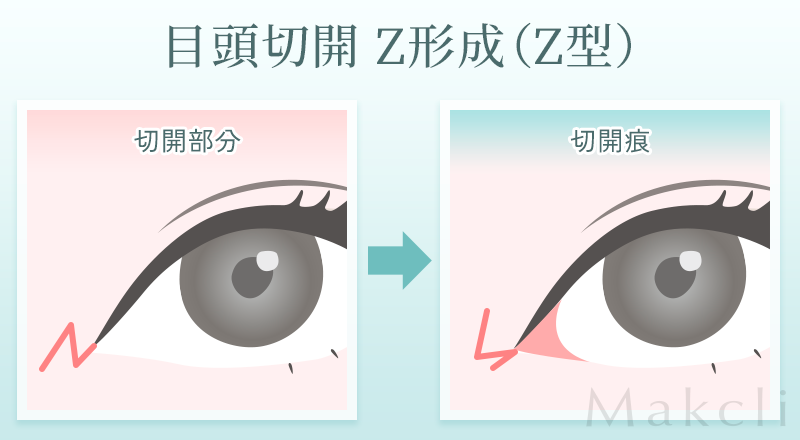 Z形成（Z型）